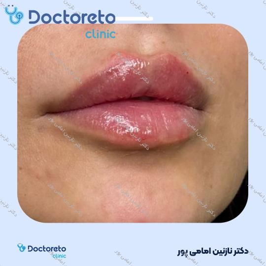 تزریق ژل لب با برند استایلج ( هر سی سی )