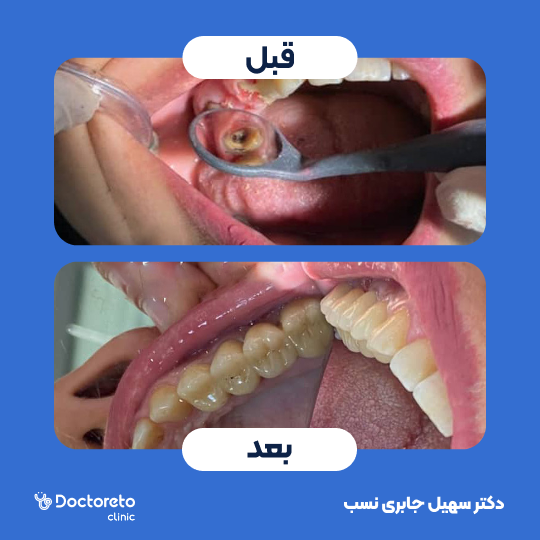 پرکردن دندان دو سطحی با کامپوزیت