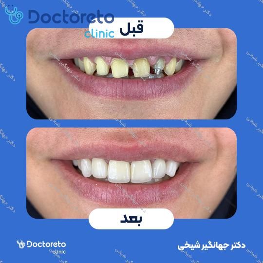 روکش دندان سرامیکی زیرکونیا (هر واحد) دکتر جهانگیر شیخی در مشهد 2