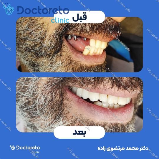 روکش دندان PFM (هر واحد) دکتر محمد مرتضوی زاده در تهران 3