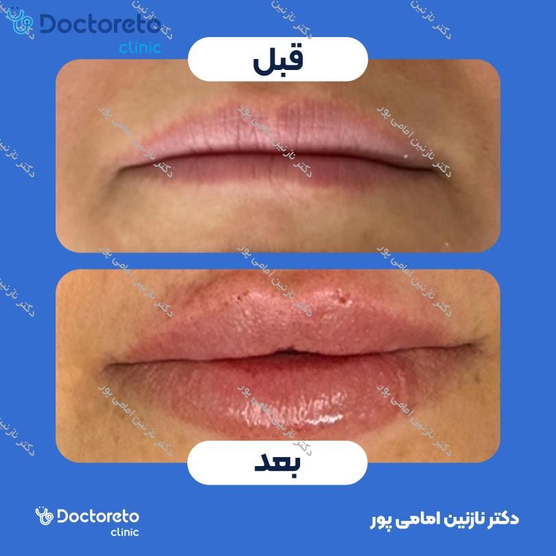 تزریق ژل لب با برند فیوریج ( هر سی سی )