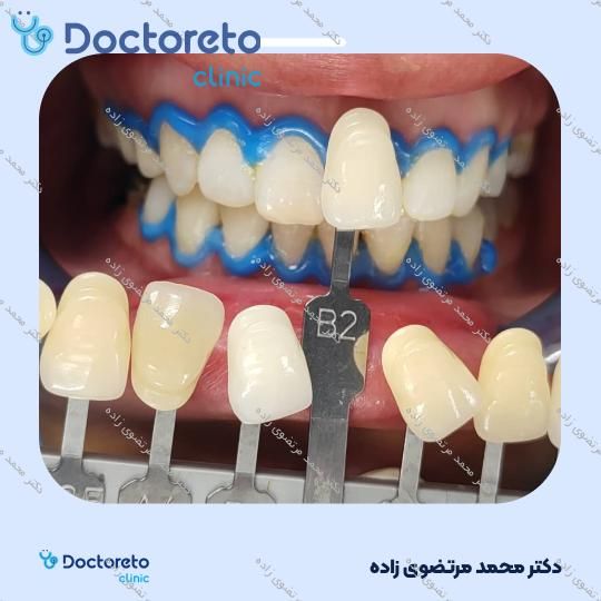 روکش دندان PFM (هر واحد) دکتر محمد مرتضوی زاده در تهران 3