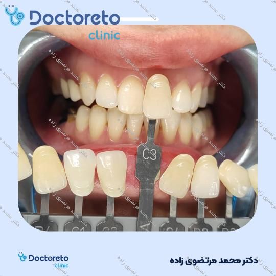 روکش دندان PFM (هر واحد)