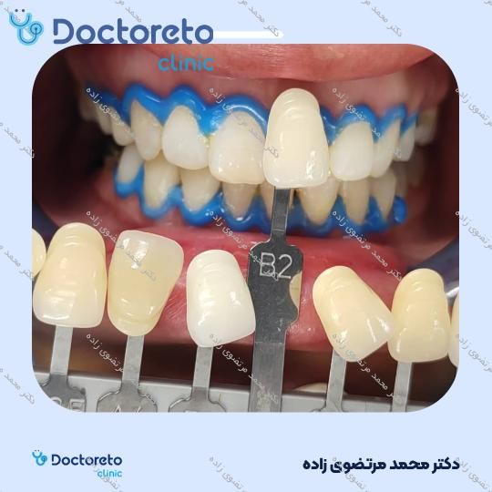روکش دندان PFM (هر واحد) دکتر محمد مرتضوی زاده در تهران 2