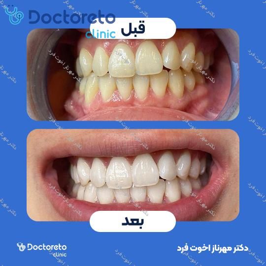 آفیس بلیچینگ (سفید کردن دندان) یک فک با مواد آلمانی دکتر مهرناز اخوت فرد در شیراز 1