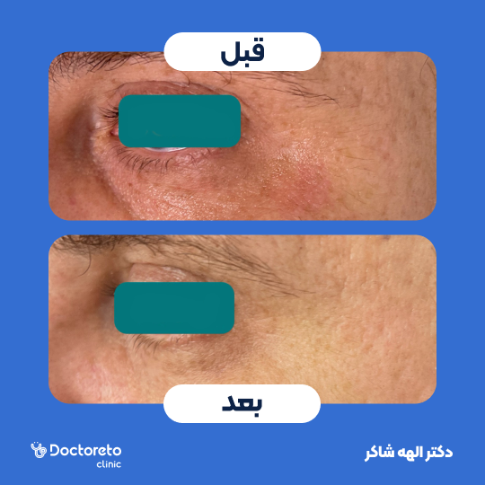 تزریق ژل زیر چشم با برند نورامیس (1cc)