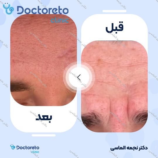 تزریق بوتاکس صورت