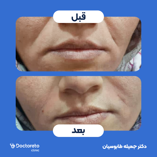 تزریق ژل خط خنده با برند رووفیل (1cc) دکتر جمیله طابوسیان در اهواز 2