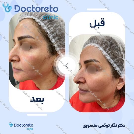هایفوتراپی گردن و غبغب با دستگاه اولترا (1 جلسه) دکتر نگار توئمی منصوری در تهران 8