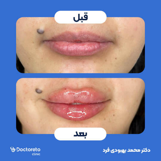 تزریق ژل لب با برند اینووسنس(1CC)