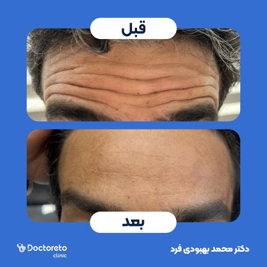 تزریق بوتاکس صورت (پیشانی ،خط اخم،دورچشم) با برند مصپورت دکتر محمد بهبودی فرد در مشهد 2