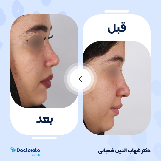 عمل جراحی مجدد زیبایی بینی (رینوپلاستی) دکتر شهاب الدین شعبانی در مشهد 21