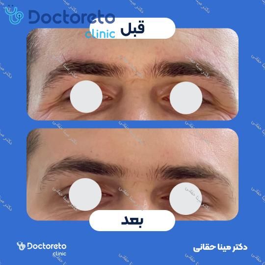 تزریق بوتاکس صورت (پیشانی، خط اخم، پنجه کلاغی) با برند مصپورت دکتر مینا حقانی در اصفهان 9