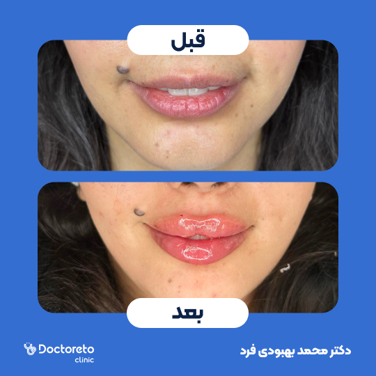 تزریق ژل لب با برند رووفیل پلاس (1cc) دکتر محمد بهبودی فرد در مشهد 3