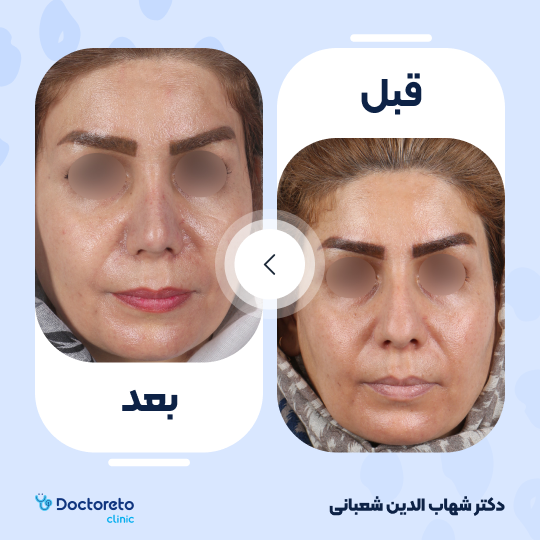 عمل زیبایی بینی (رینوپلاستی) دکتر شهاب الدین شعبانی در مشهد 33