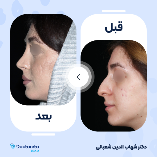 عمل جراحی مجدد زیبایی بینی (رینوپلاستی) دکتر شهاب الدین شعبانی در مشهد 25