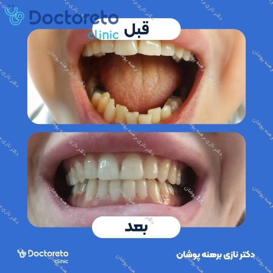 ونیر کامپوزیت اولترادنت آمریکایی (هر واحد) دکتر نازی برهنه پوشان در تهران 17