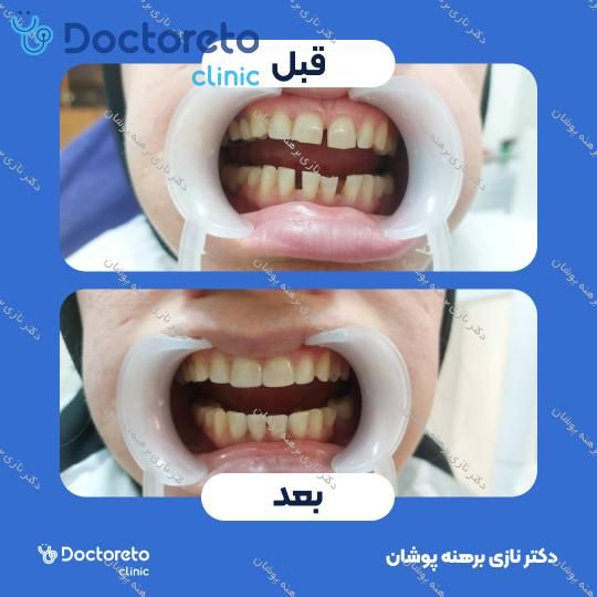 ونیر کامپوزیت توکویاما ژاپن (هر واحد) دکتر نازی برهنه پوشان در تهران 18