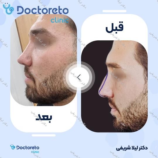 عمل زیبایی بینی (رینوپلاستی)