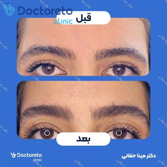 تزریق بوتاکس صورت (پیشانی، خط اخم، پنجه کلاغی) با برند مصپورت