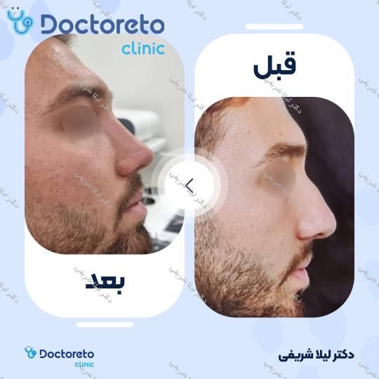 مشاوره جراحی انحراف بینی (سپتوپلاستی)