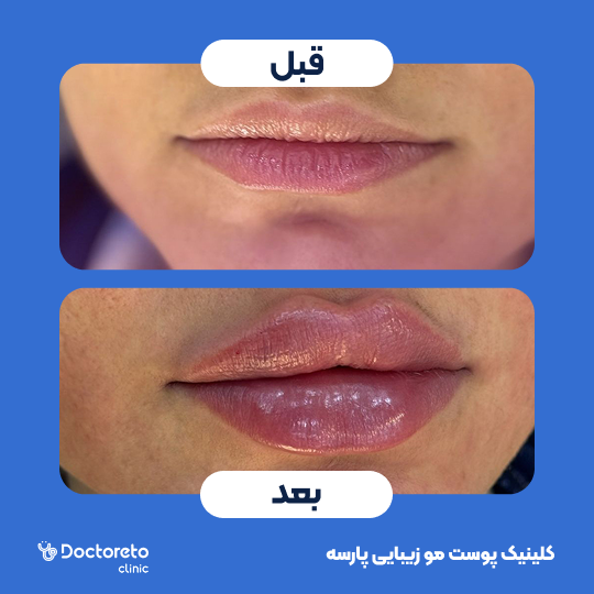 تزریق ژل لب با برند رووفیل (1cc)
