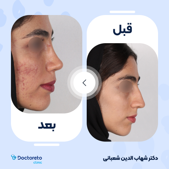 عمل جراحی مجدد زیبایی بینی (رینوپلاستی) دکتر شهاب الدین شعبانی در مشهد 43