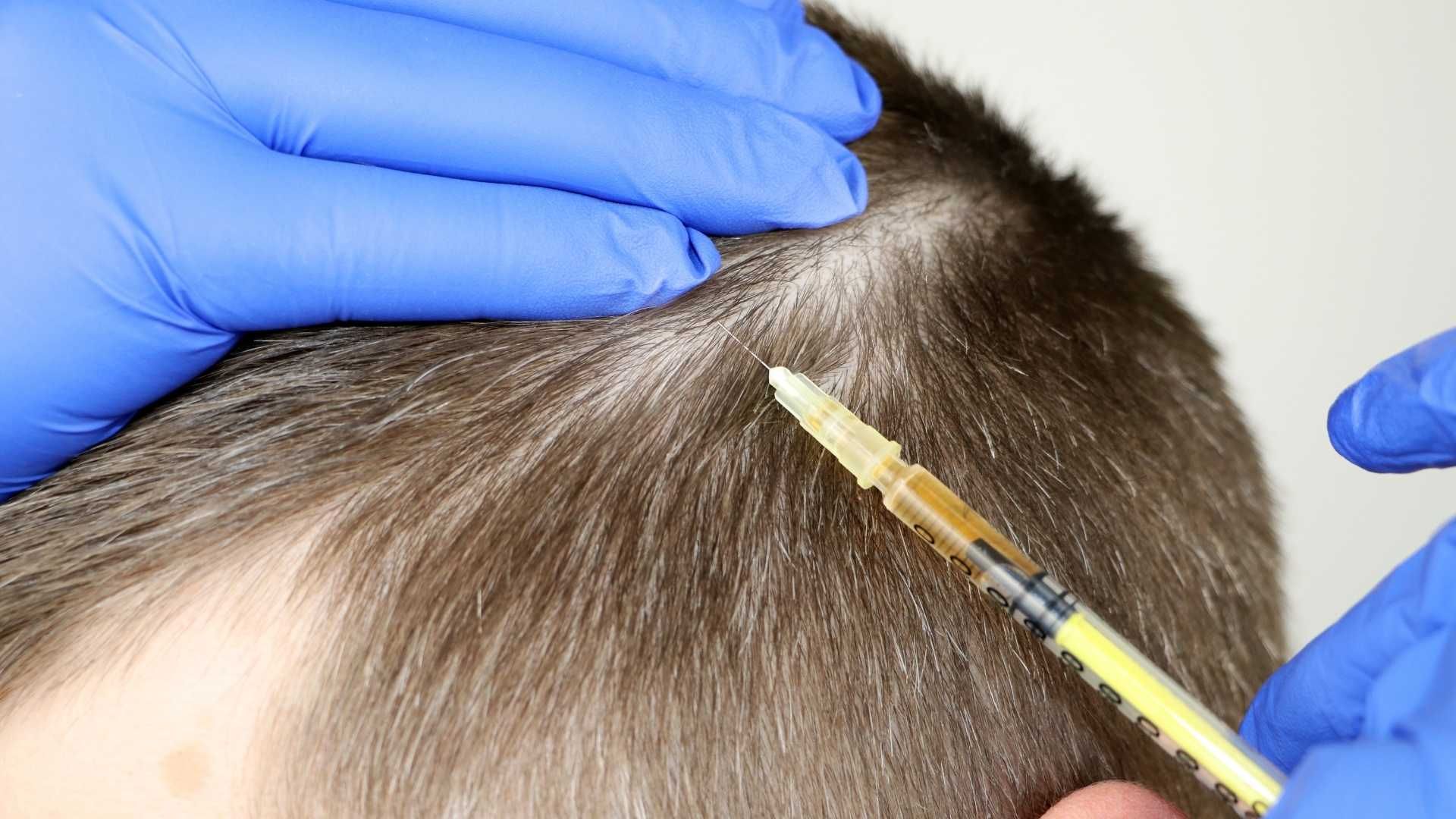 مزوتراپی مو با برند بلامین آمریکا (هر جلسه)
