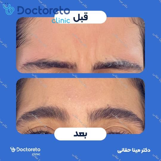 تزریق بوتاکس میگرن با برند مصپورت