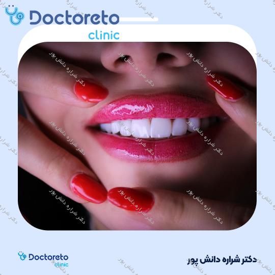 ونیر کامپوزیت سارمکو سوئیس (هر واحد) دکتر شراره دانش پور در تهران 5