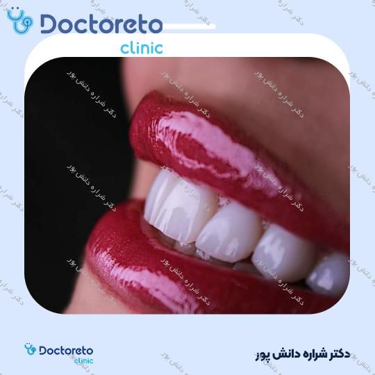 ونیر کامپوزیت سارمکو سوئیس (هر واحد) دکتر شراره دانش پور در تهران 7