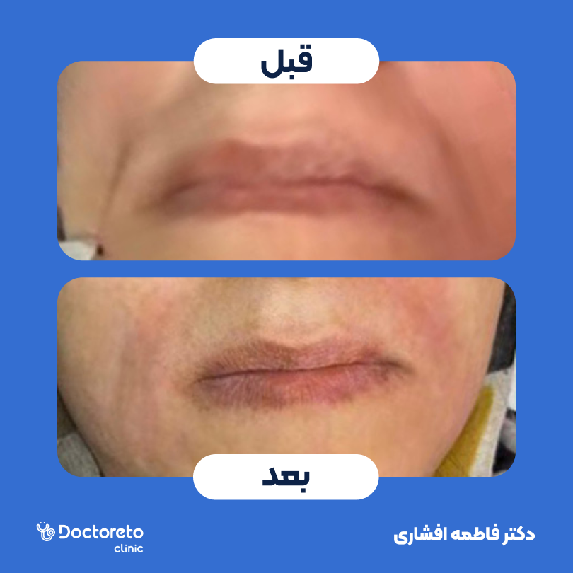 تزریق ژل خط خنده با برند درموفیل (1cc) دکتر فاطمه افشاری در کرج 2