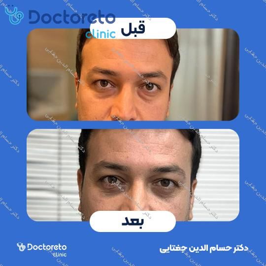 بلفاروپلاستی پلک بالا به روش جراحی دکتر حسام الدین جغتایی در ساری 5