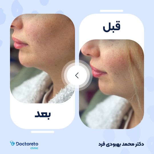 تزریق ژل لب با برند رووفیل پلاس (1cc) دکتر محمد بهبودی فرد در مشهد 8