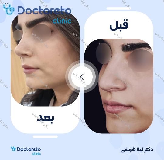 عمل زیبایی بینی (رینوپلاستی)