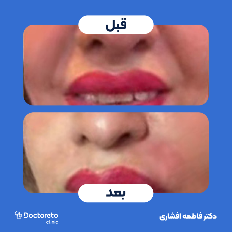 تزریق ژل خط خنده با برند درموفیل (1cc)
