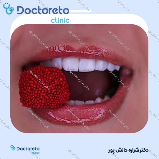 ونیر کامپوزیت سارمکو سوئیس (هر واحد) دکتر شراره دانش پور در تهران 4