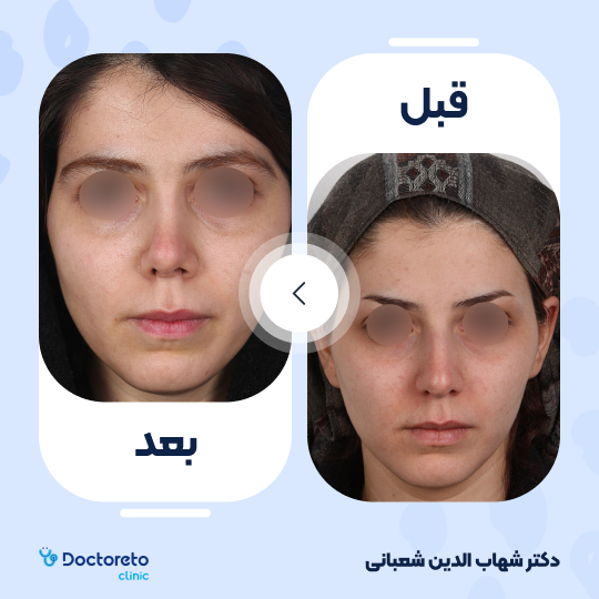 عمل زیبایی بینی (رینوپلاستی) دکتر شهاب الدین شعبانی در مشهد 23