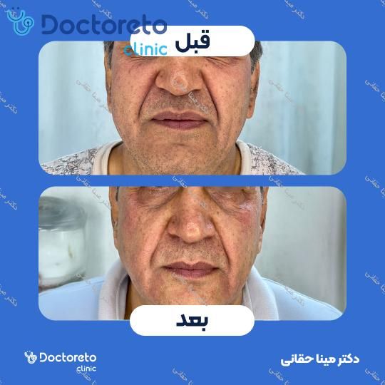 جوانسازی، آبرسانی و کلاژن سازی صورت با مزوژل جالپرو HMW صورتی (هر جلسه) دکتر مینا حقانی در اصفهان 8