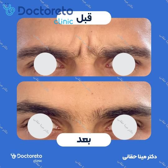 تزریق بوتاکس میگرن با برند مصپورت