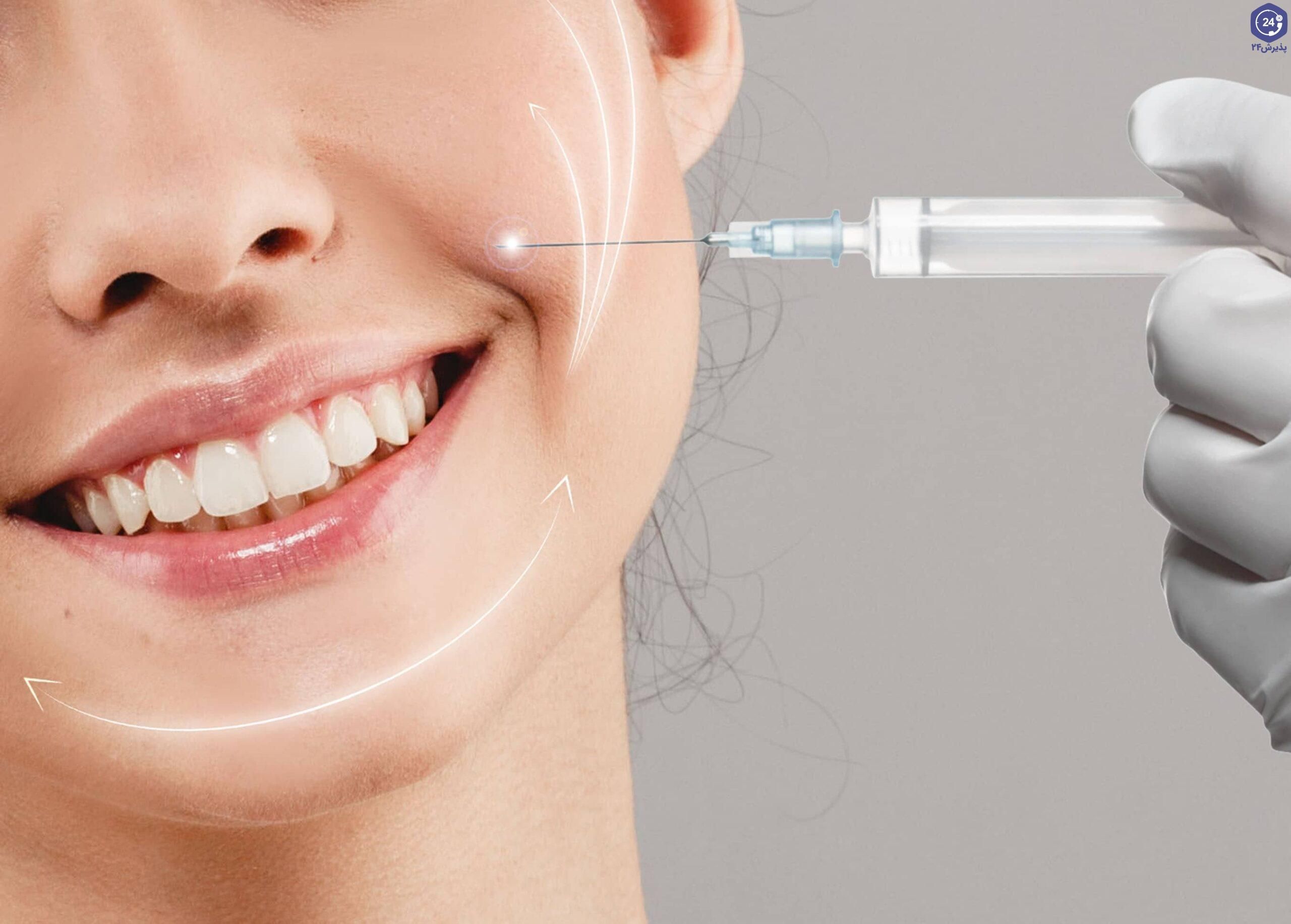 تزریق ژل خط خنده با برند استایلج (1cc)