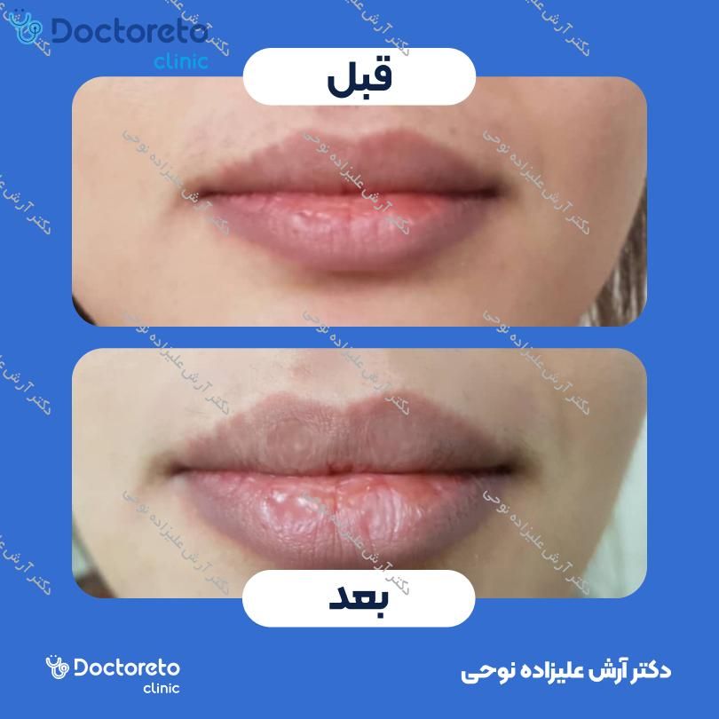 تزریق ژل لب با برند رووفیل (1cc)