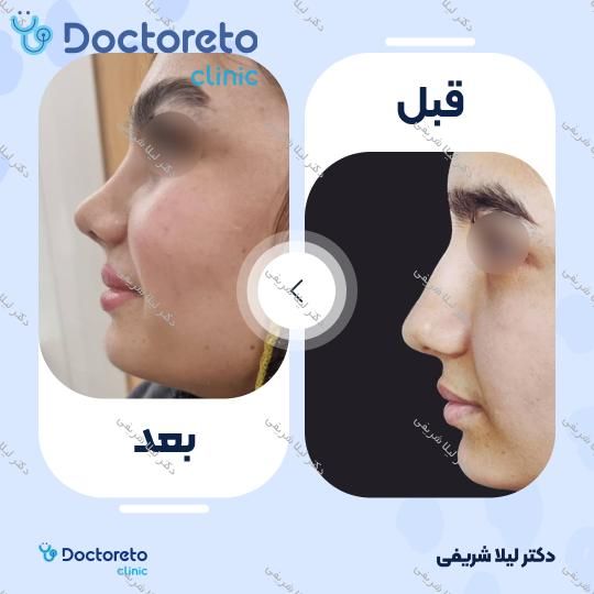 عمل زیبایی بینی (رینوپلاستی)