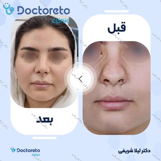 عمل زیبایی بینی (رینوپلاستی)