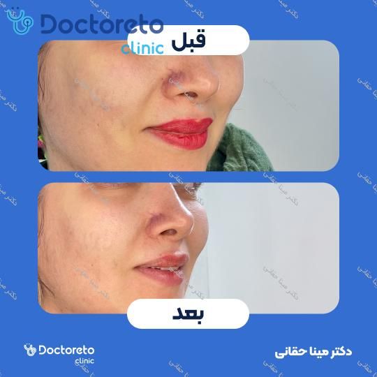 جوانسازی، لیفت و آبرسانی عمیق صورت با مزوژل جالپرو سوپرهیدرو (هرجلسه)