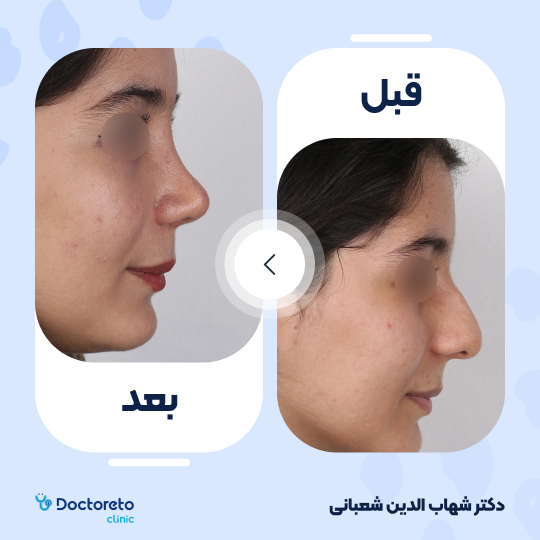 عمل جراحی مجدد زیبایی بینی (رینوپلاستی) دکتر شهاب الدین شعبانی در مشهد 38
