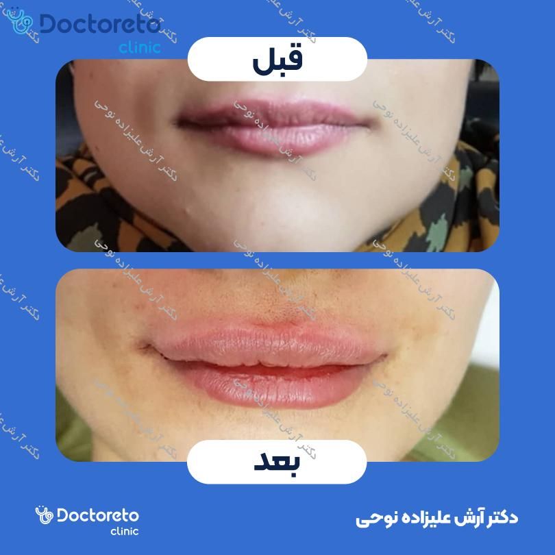 تزریق ژل لب با برند نورافیل (1cc)