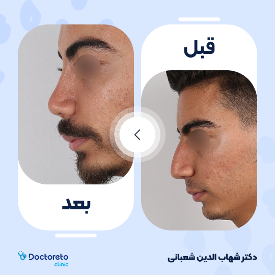 عمل جراحی مجدد زیبایی بینی (رینوپلاستی) دکتر شهاب الدین شعبانی در مشهد 31