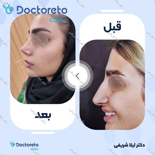 عمل زیبایی بینی (رینوپلاستی)