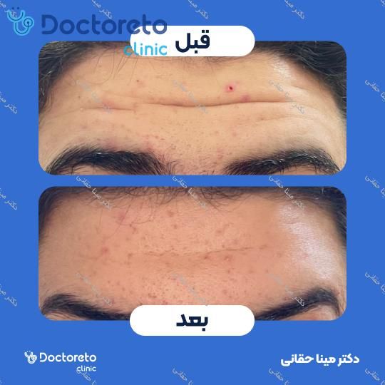 تزریق بوتاکس صورت (پیشانی، خط اخم، پنجه کلاغی) با برند مصپورت دکتر مینا حقانی در اصفهان 3